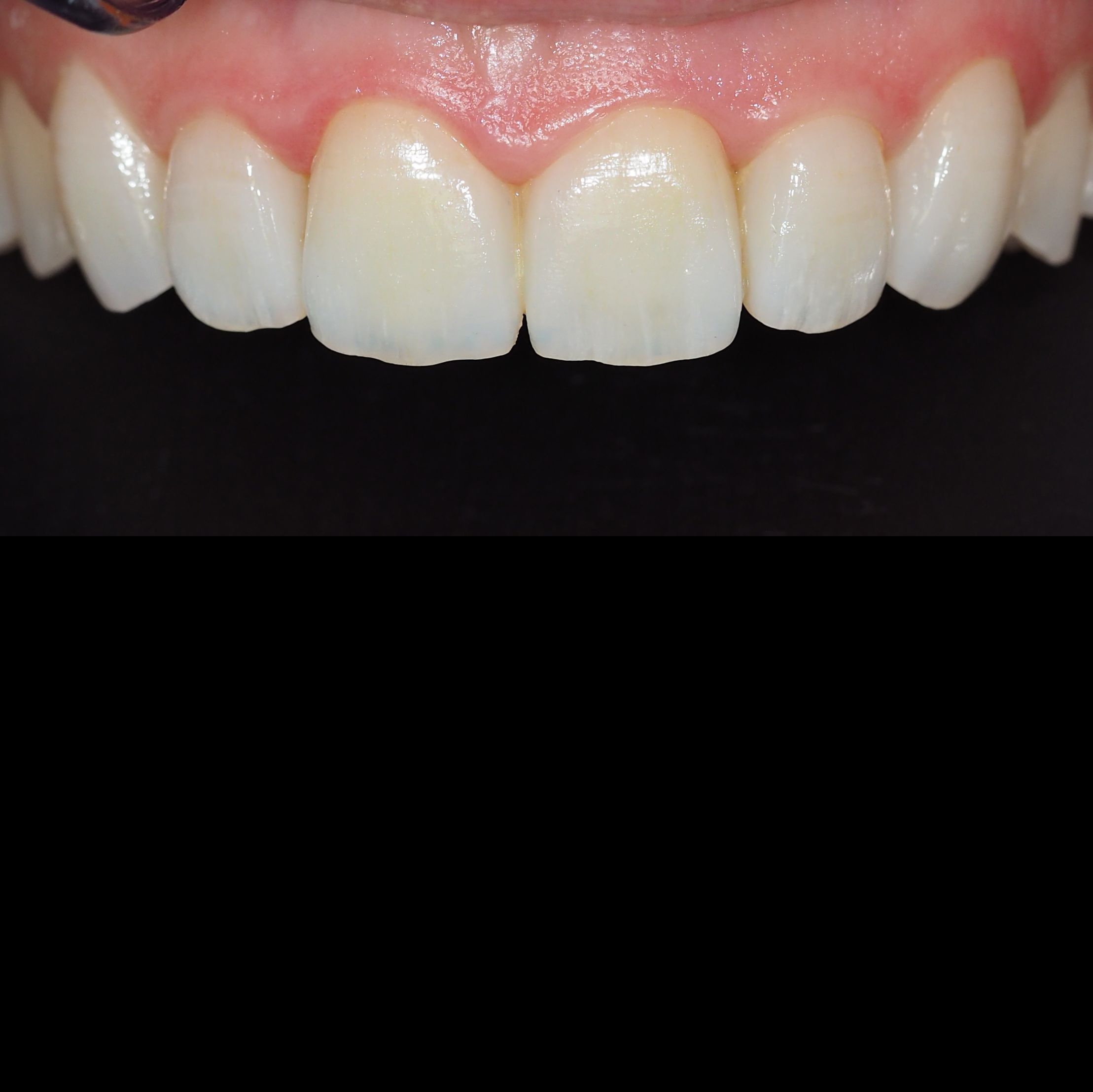 Identic Lab Carillas dentales